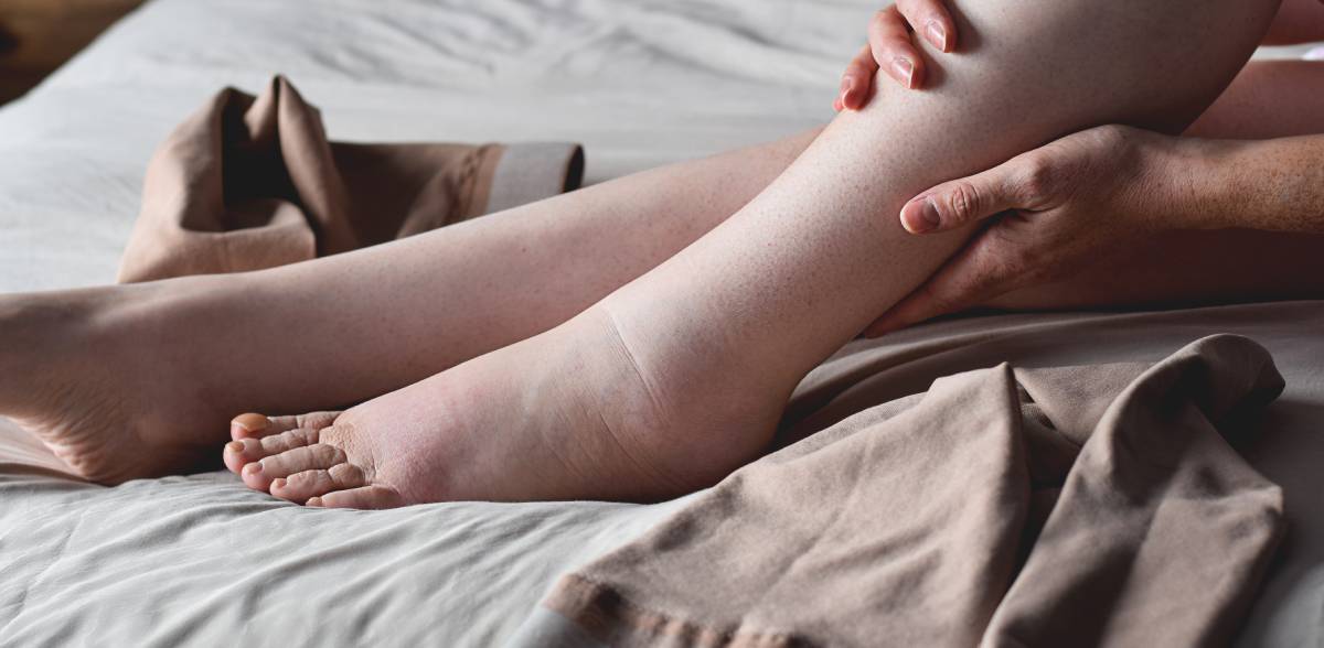 Lymphedema Care in Winnipeg: What It Is and How Liberty Medical Can Help